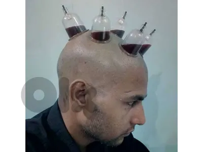 cupping